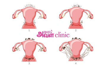 Endometriosis Stage 4 Thumbnail