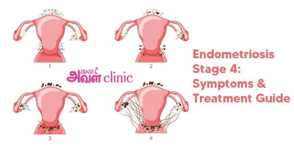 Stage 4 Endometriosis  banner 
