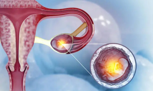Ectopic Pregnancy Treatment